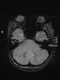 Amyotrophic lateral sclerosis (Radiopaedia 70821-81017 Axial SWI 8).jpg