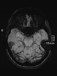 File:Amyotrophic lateral sclerosis (Radiopaedia 70821-81017 Axial SWI minIP 13).jpg