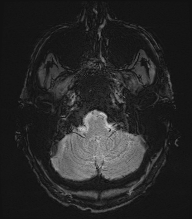 Amyotrophic lateral sclerosis (Radiopaedia 87352-103658 Axial SWI 2).jpg