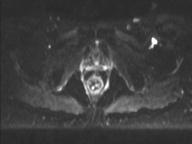 Anal adenocarcinoma - tumor regression grade 1 (Radiopaedia 31358-32100 Axial DWI 15).jpg