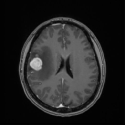 File:Anaplastic astroblastoma (Radiopaedia 55666-62194 Axial T1 C+ 48).png