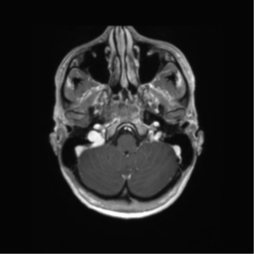 File:Anaplastic astrocytoma IDH mutant (Radiopaedia 50046-55341 Axial T1 C+ 10).png