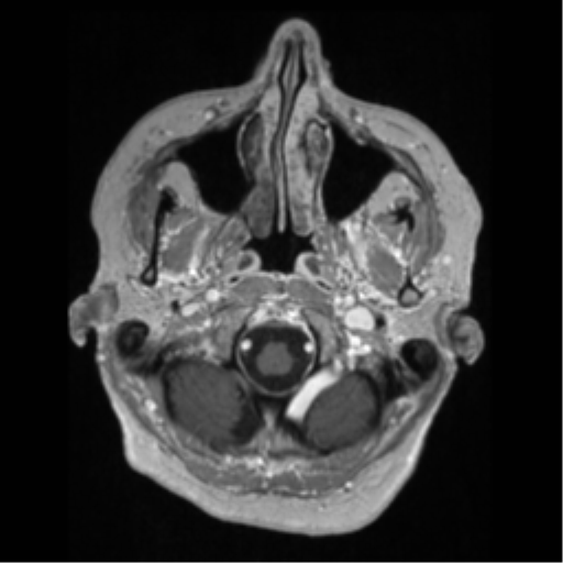 File:Anaplastic astrocytoma IDH wild-type (pseudoprogression) (Radiopaedia 42209-45276 Axial T1 C+ 20).png