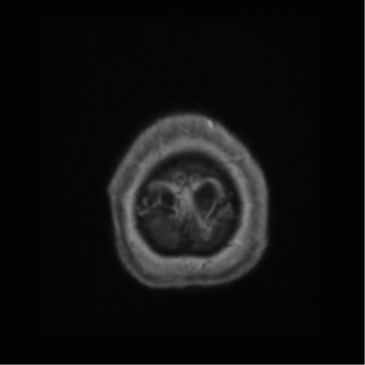 Anaplastic astrocytoma IDH wild-type (pseudoprogression) (Radiopaedia 42209-45277 Axial T1 C+ 128).png