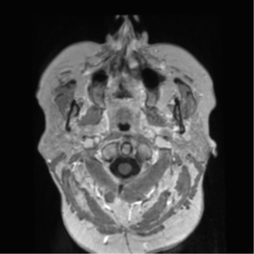 File:Anaplastic astrocytoma IDH wild-type (pseudoprogression) (Radiopaedia 42209-45278 Axial T1 C+ 11).png