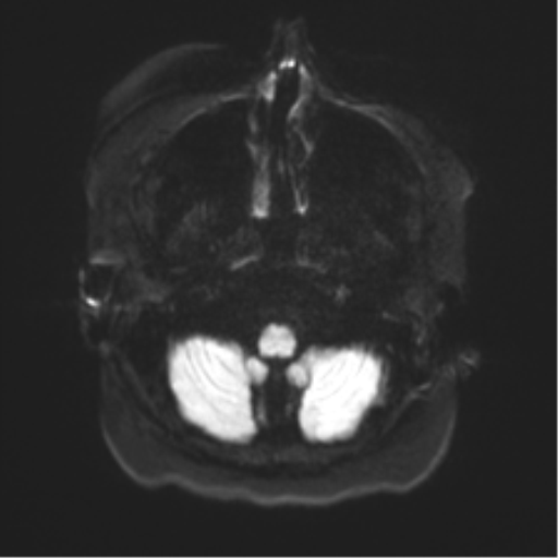 Anaplastic astrocytoma IDH wild-type (pseudoprogression) (Radiopaedia 42209-45279 Axial DWI 30).png