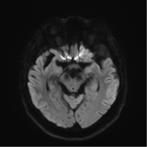 File:Anaplastic astrocytoma IDH wild-type (pseudoprogression) (Radiopaedia 42209-45279 Axial DWI 38).png