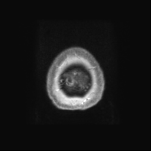 Anaplastic astrocytoma IDH wild-type (pseudoprogression) (Radiopaedia 42209-45279 Axial T1 C+ 141).png