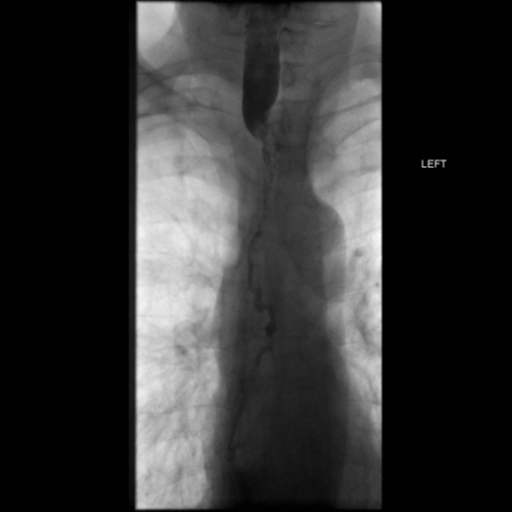 File:Anastomotic stricture post Ivor Lewis esophagectomy (Radiopaedia 47937-52715 B 19).png
