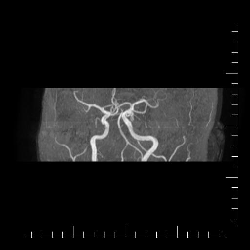 File:Aneurysm of posterior communicating artery (Radiopaedia 20188-20163 MRA 9).jpg
