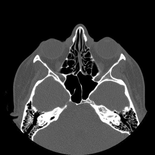 Aneurysmal bone cyst of the mandible (Radiopaedia 43280-46823 Axial bone window 161).jpg