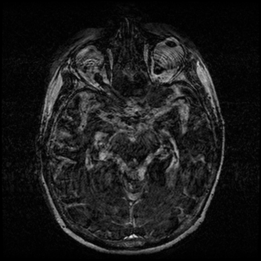Angioinvasive aspergillosis in the pituitary fossa (Radiopaedia 39676-42010 Ax 3D FIESTA VOLUME 71).png