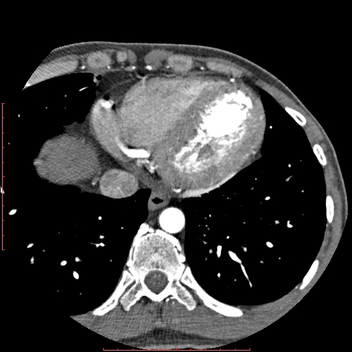 Anomalous left coronary artery from the pulmonary artery (ALCAPA) (Radiopaedia 70148-80181 A 304).jpg