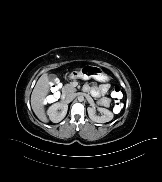 Anterior abdominal wall CSF pseudocyst (CSFoma) (Radiopaedia 79453-92571 A 35).jpg