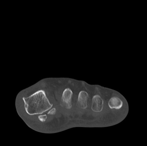 Anterior calcaneal process fracture (Radiopaedia 47384-51989 Coronal bone window 24).png