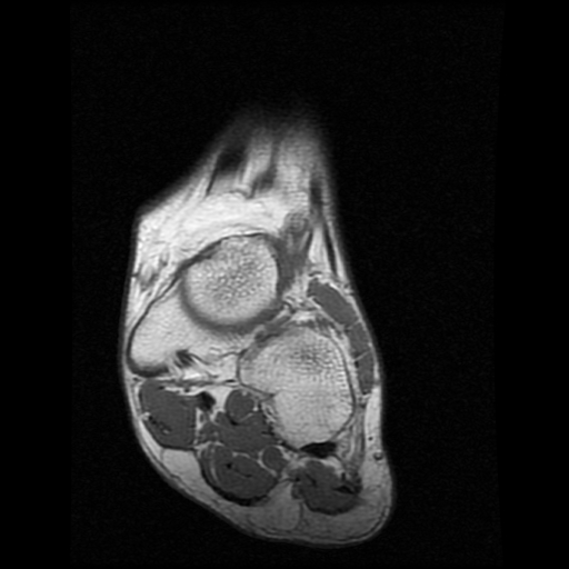 File:Anterior calcaneal process fracture (Radiopaedia 74654-85611 Coronal T1 3).jpg