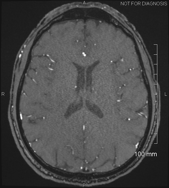 Anterior cerebral artery aneurysm (Radiopaedia 80683-94127 Axial MRA 151).jpg