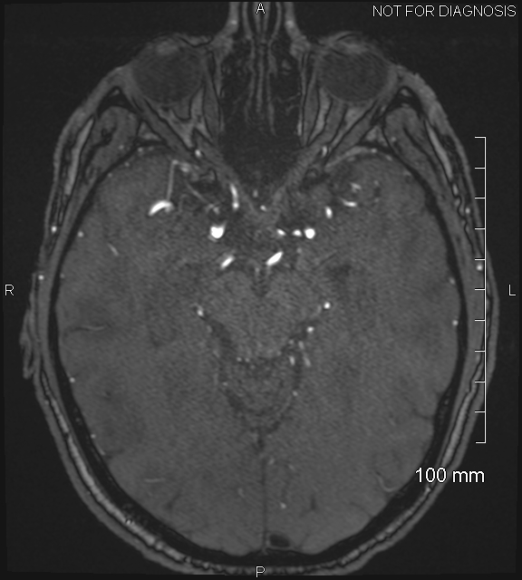 Anterior cerebral artery aneurysm (Radiopaedia 80683-94127 Axial MRA 97).jpg