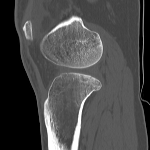 File:Anterior cruciate ligament avulsion fracture (Radiopaedia 58939-66194 Sagittal bone window 11).jpg
