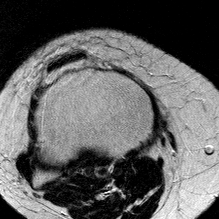 File:Anterior cruciate ligament mucoid degeneration (Radiopaedia 60853-68633 Axial T2 8).jpg