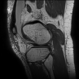 Anterior cruciate ligament rupture with Segond fracture (Radiopaedia 69043-78806 Sagittal PD 144).jpg