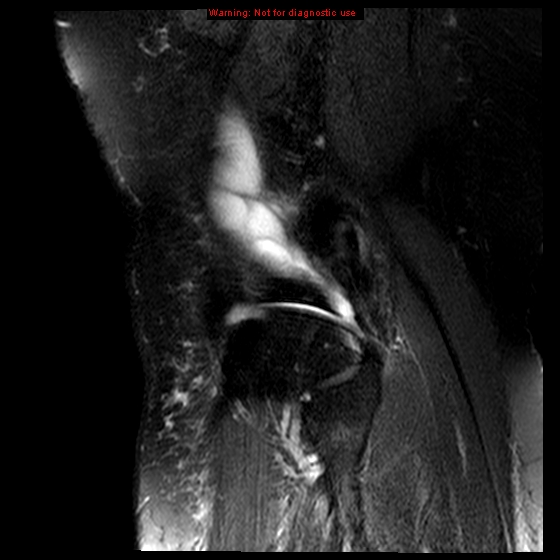 File:Anterior cruciate ligament tear (Radiopaedia 12329-12612 E 3).jpg