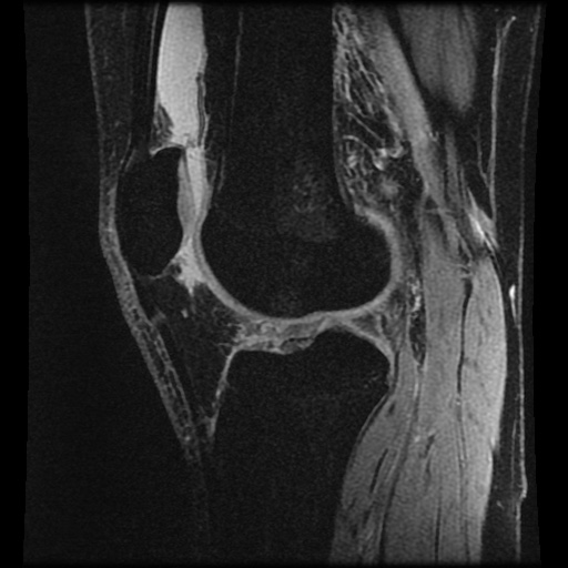 File:Anterior cruciate ligament tear (Radiopaedia 61500-69462 F 53).jpg
