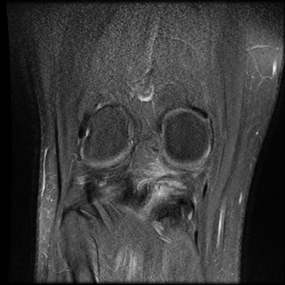 File:Anterior cruciate ligament tear with posteromedial corner injury, bucket-handle meniscal tear and chondral delamination (Radiopaedia 75501-86744 Coronal PD fat sat 20).jpg