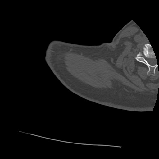 Anterior glenohumeral dislocation with Hill-Sachs lesion (Radiopaedia 62877-71249 Axial bone window 2).jpg