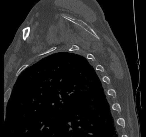 File:Anterior glenohumeral dislocation with Hill-Sachs lesion (Radiopaedia 62877-71249 Sagittal bone window 57).jpg