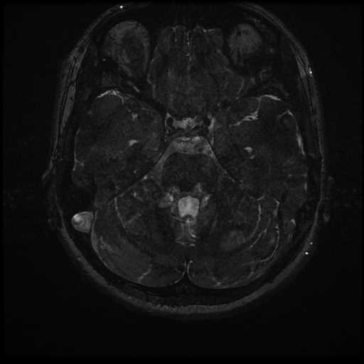 Anterior inferior cerebellar artery vascular loop - type II (Radiopaedia 70991-81209 Axial 3D FIESTA 5).jpg