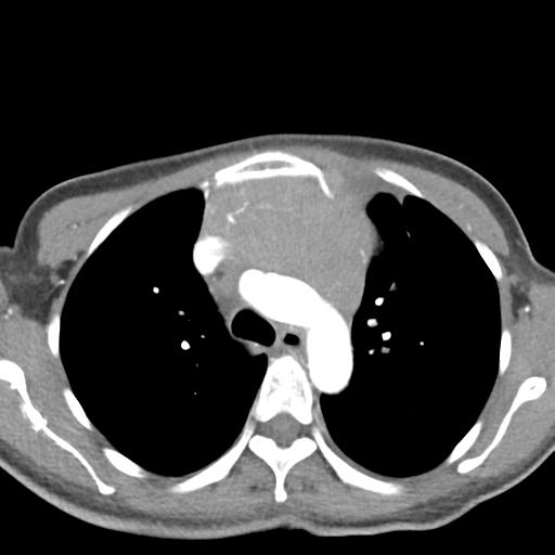 File:Anterior mediastinal lymphoma (Radiopaedia 29556-30061 C 17).jpg