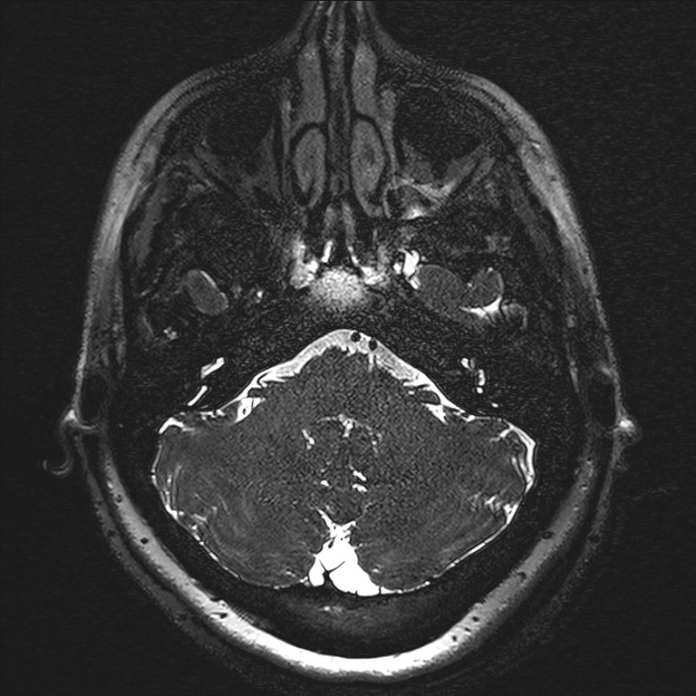 Anterior temporal encephalocele (Radiopaedia 82624-96808 Axial T2 high res 3).jpg