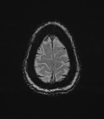 Anterior temporal pole cysts (Radiopaedia 46629-51102 Axial SWI 80).png
