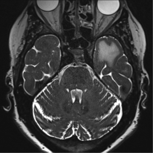 Anterior temporal pole cysts (Radiopaedia 46629-51102 Axial T2 51).png