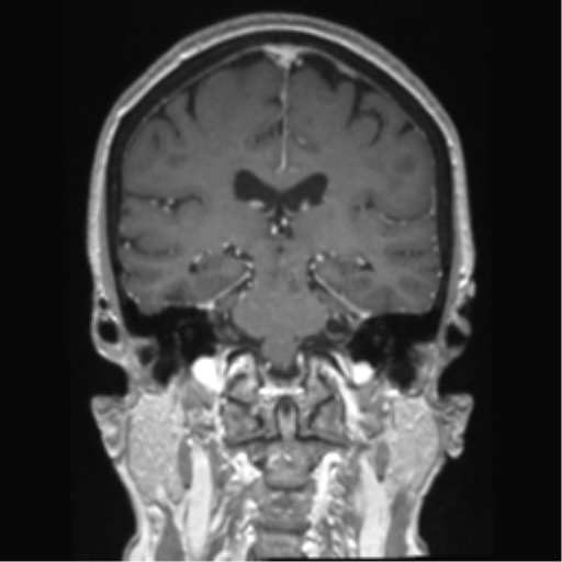 Anterior temporal pole cysts (Radiopaedia 46629-51102 Coronal T1 C+ 75).png