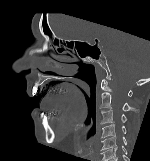 Anterior temporomandibular joint dislocation (Radiopaedia 59430-66784 B 35).jpg