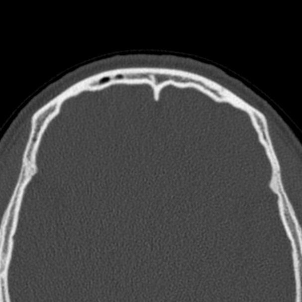 Antrochoanal polyp (Radiopaedia 33984-35202 Axial bone window 80).jpg