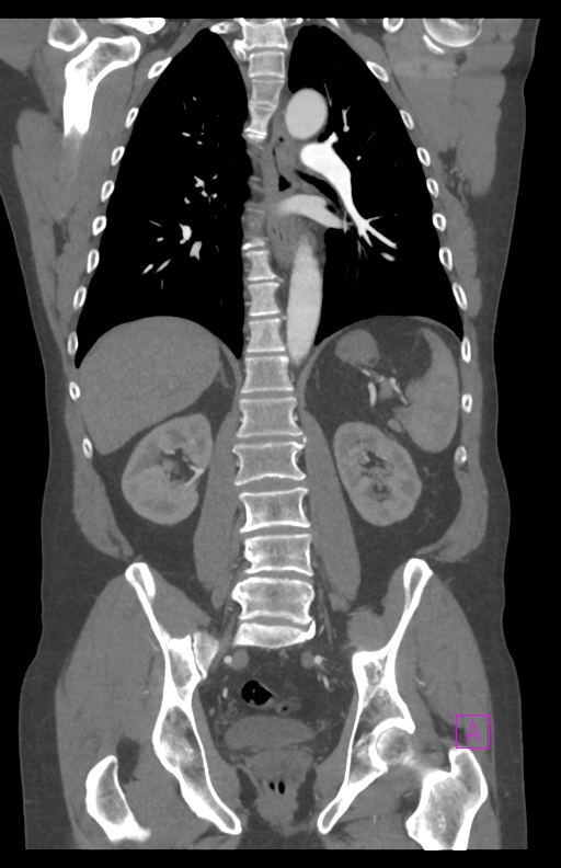 Aortectomy and axillary-bifemoral bypass (Radiopaedia 28303-28545 C 59).jpg