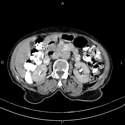 File:Aortic aneurysm and Lemmel syndrome (Radiopaedia 86499-102554 Axial C+ delayed 34).jpg