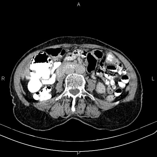 File:Aortic aneurysm and Lemmel syndrome (Radiopaedia 86499-102554 Axial C+ delayed 42).jpg