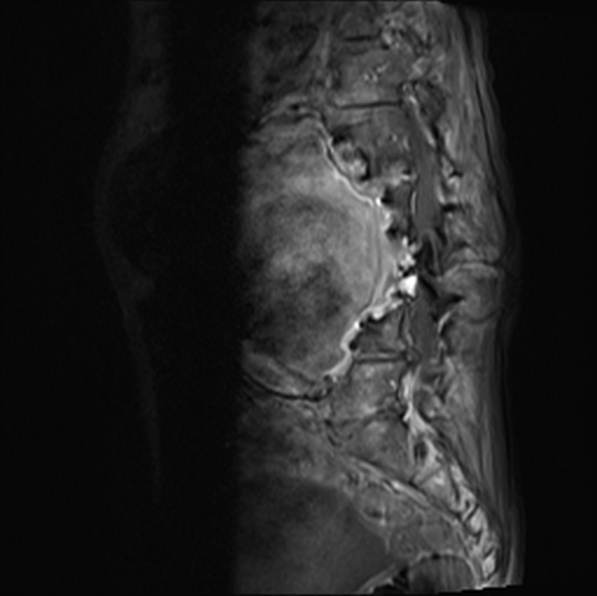 File:Aortic aneurysm with spinal destruction (Radiopaedia 42301-45409 Sagittal T1 fat sat 27).jpg