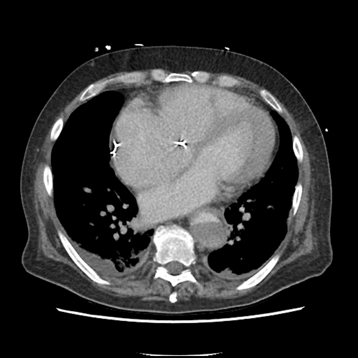 Aortic arch graft infection (FDG PET-CT) (Radiopaedia 71975-82437 A 40).jpg