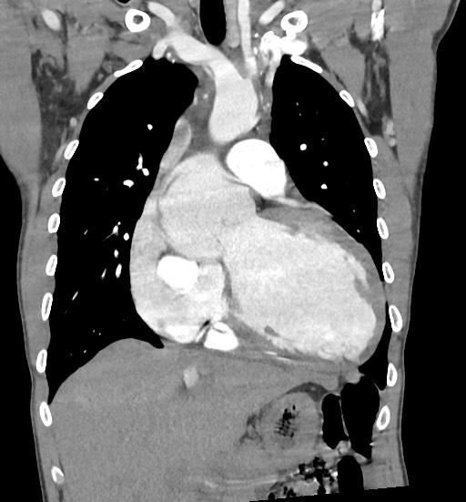 Aortic coarctation with aneurysm (Radiopaedia 74818-85828 C 46).jpg