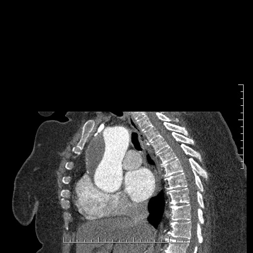 File:Aortic dissection- Stanford A (Radiopaedia 35729-37268 D 32).jpg