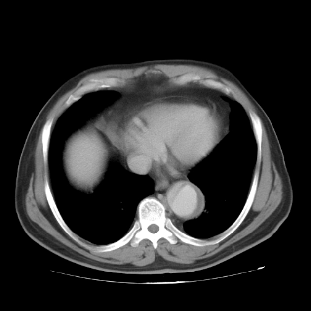 Aortic dissection (Radiopaedia 44411-48061 C 65).jpg