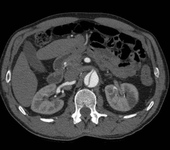File:Aortic dissection - Stanford type B (Radiopaedia 73648-84437 A 139).jpg