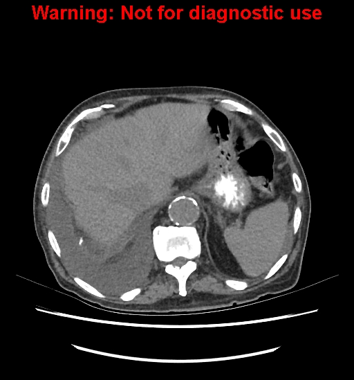 File:Aortic graft infection (Radiopaedia 44979-48907 Axial non-contrast 24).jpg