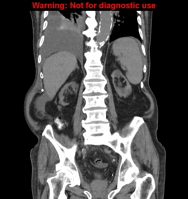 Aortic graft infection (Radiopaedia 44979-48907 non-contrast 34).jpg