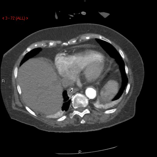 Aortic intramural hematoma (Radiopaedia 27746-28001 A 72).jpg